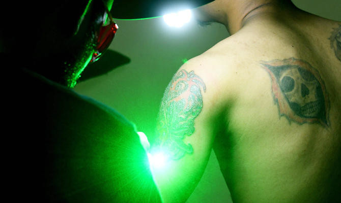 Indonesia's tattoo removers zap the sin from your skin | Arab News PK